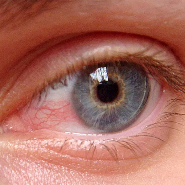 Glaucoma