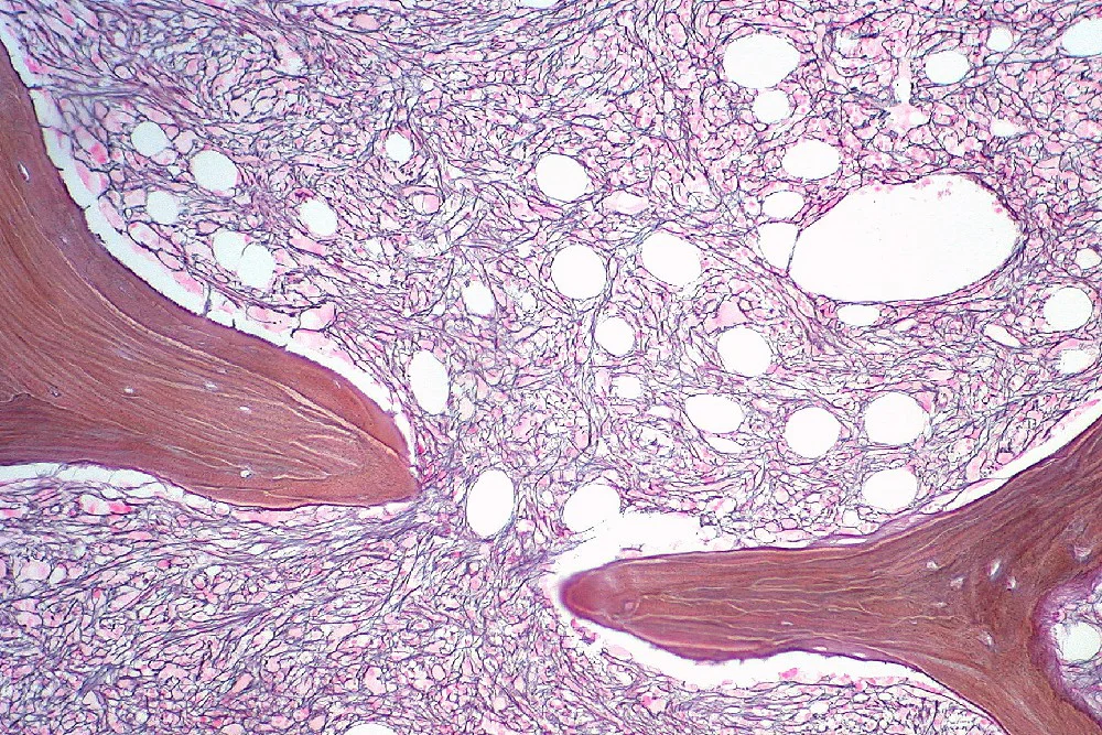 Aumento de reticulina en la médula ósea en el trastorno mieloproliferativo~1
