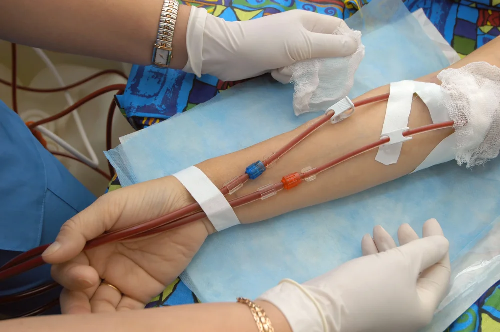 fistula
